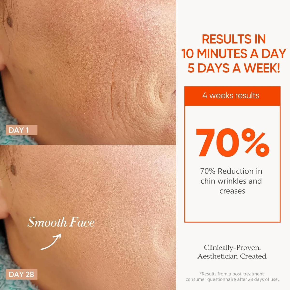 Close-up before and after images showing significant facial skin improvement with 70 percent reduction in chin wrinkles after 28 days using 7 Color Rechargeable LED therapy
