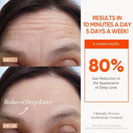 7 Color Rechargeable LED skincare results showing reduced deep forehead lines after 28 days of use with 80% improvement